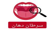 سرطان دهان؛یکی از مرگبارترین انواع سرطان‌ها در تمام جهان